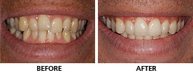 Crowded and Uneven Teeth